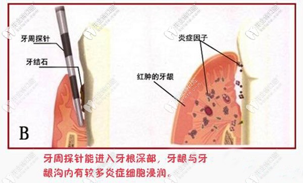 牙周治疗固定术