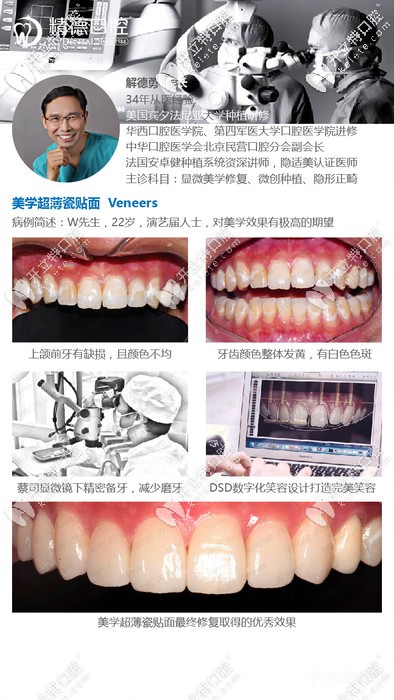 精德口腔解德勇院长的牙齿贴面案例 精德口腔解德勇院长的牙齿贴面案例