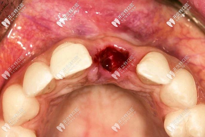 干槽症早期症状图片