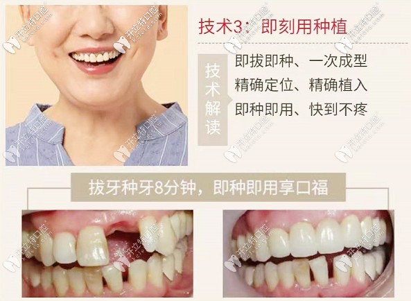 <!--<i data=20240703-sp></i>-->口腔种植牙技术
