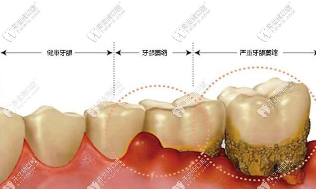 牙龈萎缩情况