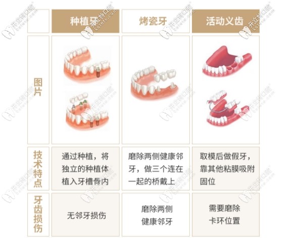 种植牙和传统假牙对比图