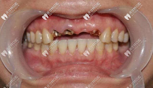 上门牙缺失四颗怎么修复，做种植牙是不是缺几颗种几颗？