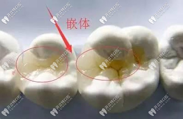 嵌体补牙的图片