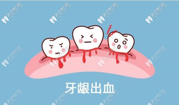 牙周炎导致的牙龈出血
