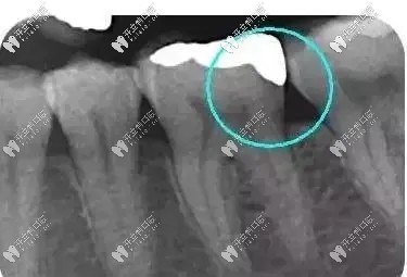 牙齿嵌体拍片图示