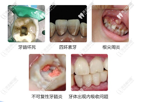 急求！在重庆做根管治疗哪家医院好？治疗一颗牙齿多少钱