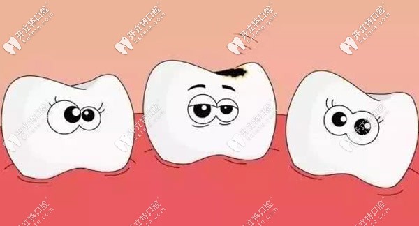 牙面黑渍会导致牙齿变黑
