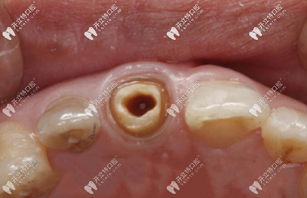 桩冠治疗牙齿预备