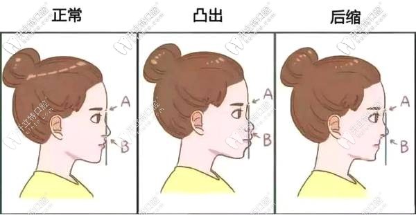 牙齿矫正脸型 牙齿矫正脸型