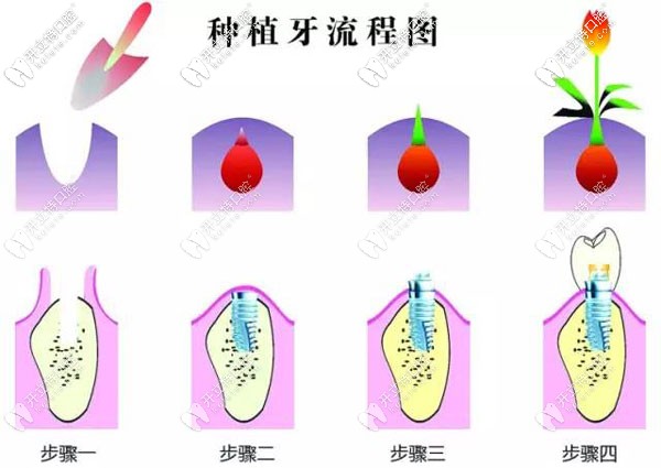 种植牙手术过程图