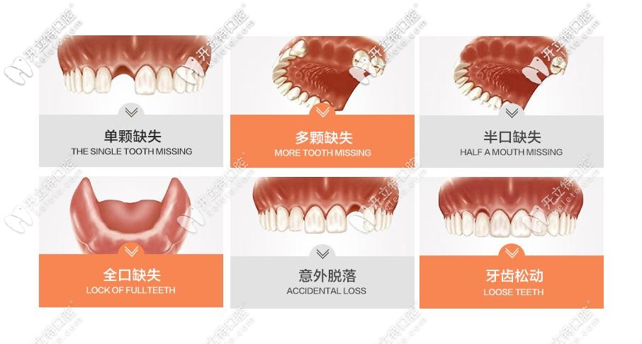种植牙适应症 种植牙适应症