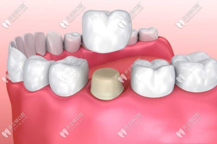 牙冠修复图解 牙冠修复图解