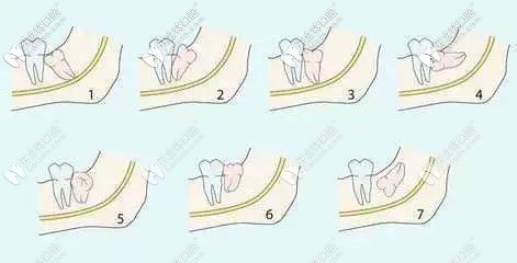 智齿的各种不同类型