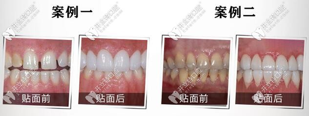 E-max铸瓷贴面案例 E-max铸瓷贴面案例