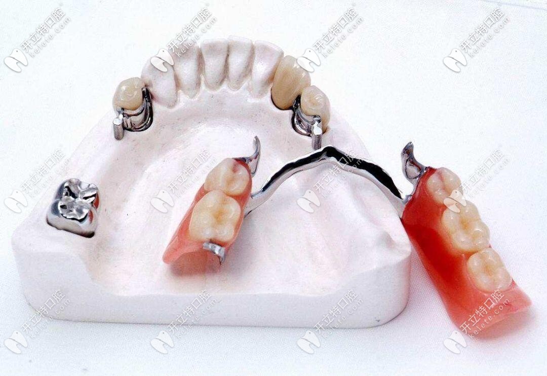 交流下精密附着体适应症和优缺点,看看这种附着体义齿多钱
