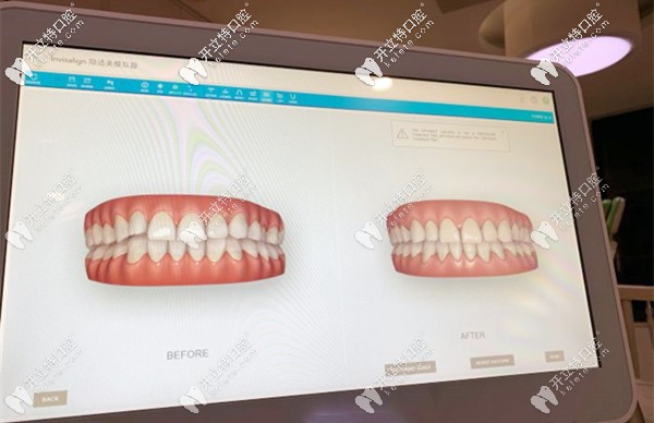 天河柏德口腔的3D口扫仪