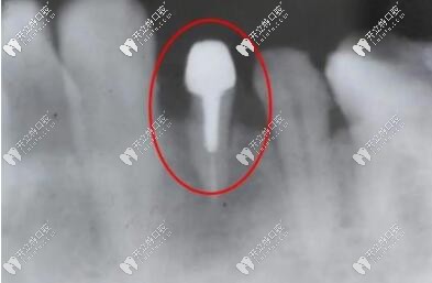 牙齿打桩后的样子