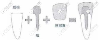 做牙套要打桩这波操作疼吗?分享烤瓷牙打桩材料及价格