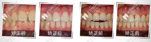 Invisalign隐适美 Invisalign隐适美