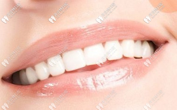 咸阳市牙科医院牙齿美白修复的价格