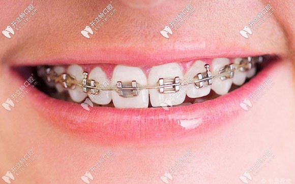 张冰医生擅长各类牙齿矫正技术