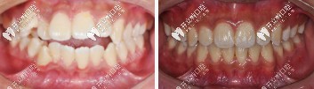 矫正牙齿前后对比 矫正牙齿前后对比