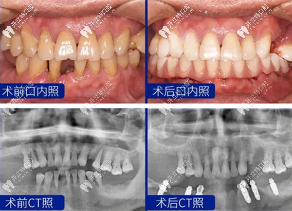 王旭医生的半口种植牙案例效果图 王旭医生的半口种植牙案例效果图