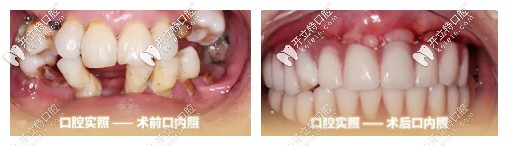 种植牙前后对比