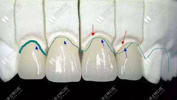 牙冠备牙肩台的分类及优缺点
