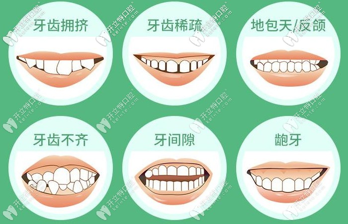 牙齿矫正的适应症状 牙齿矫正的适应症状