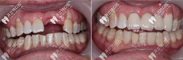 咸阳海涛口腔多颗种植牙
