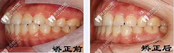 矫正前后对比 矫正前后对比