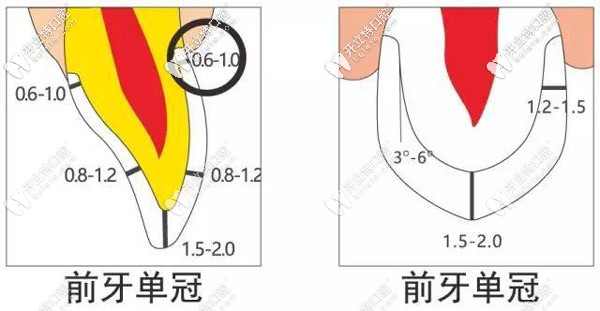 前牙冠做备牙的图解