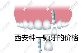 西安种一颗牙的价格