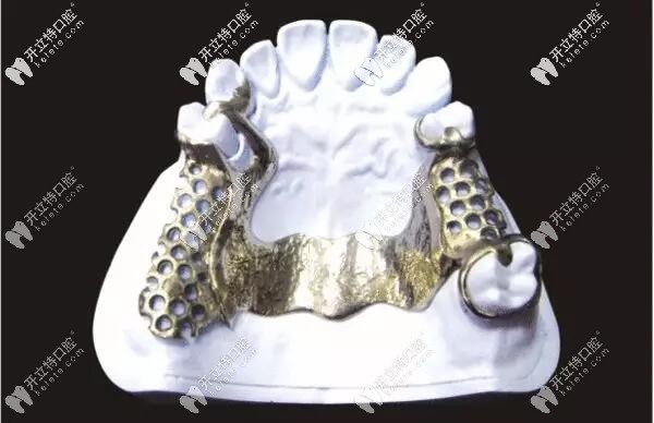 纯钛支架活动义齿图片