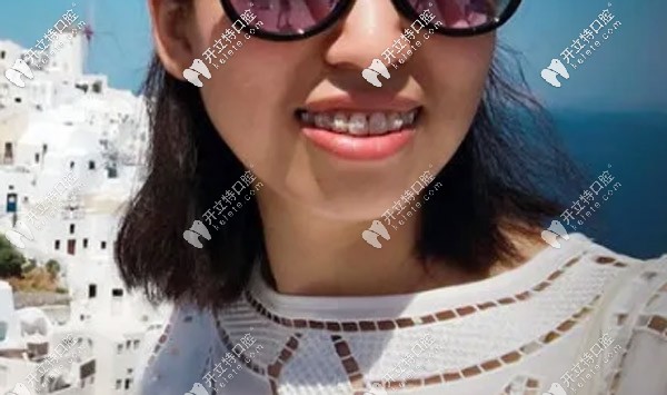 关于牙套脸的问题我来说说自己的看法 关于牙套脸的问题我来说说自己的看法