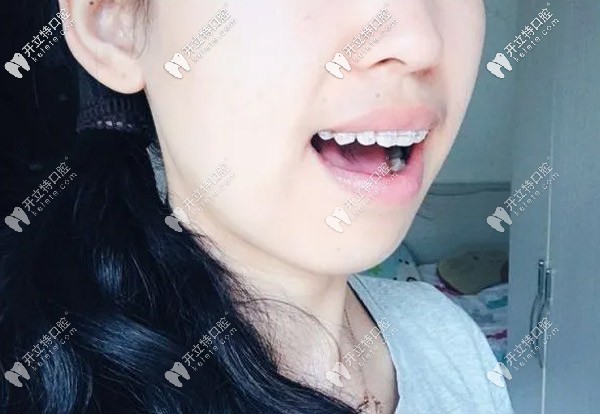 刚出医院门口托槽就掉了 刚出医院门口托槽就掉了