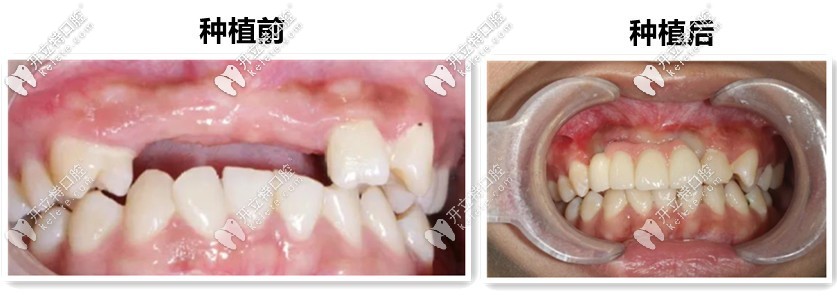 19岁妞门牙缺失4个,来吐槽“郑州唯美口腔”的种植牙技术
