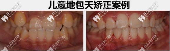 儿童地包天牙齿矫正前后