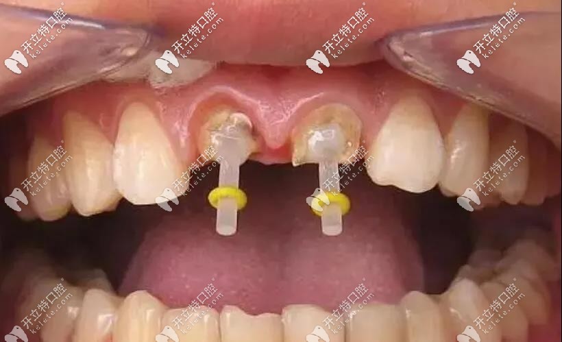 牙齿打桩的基本步骤 牙齿打桩的基本步骤