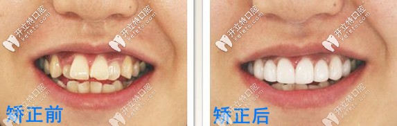 矫正前后对比 矫正前后对比