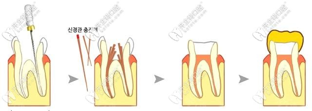 根管治疗后一定要戴牙冠哦 根管治疗后一定要戴牙冠哦