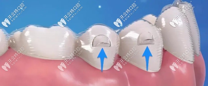 隐形牙套上的小附件