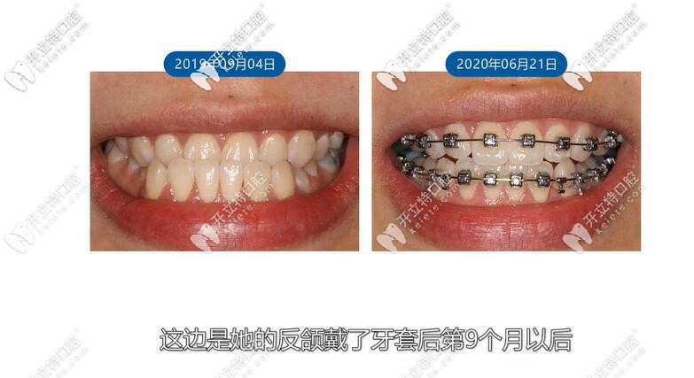 反颌牙套9个月