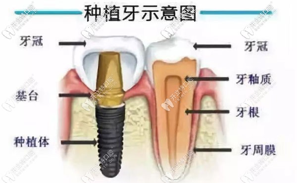 牙齿种植示意图
