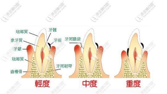 牙周炎 牙周炎