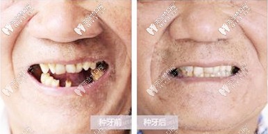 种牙前后对比 种牙前后对比