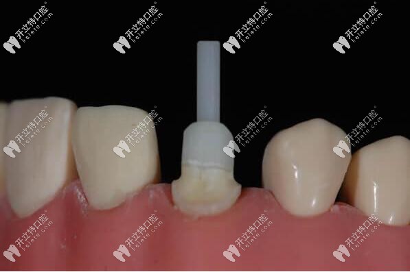 纯钛和纤维牙桩哪个好,做后牙修复的时候有什么区别吗