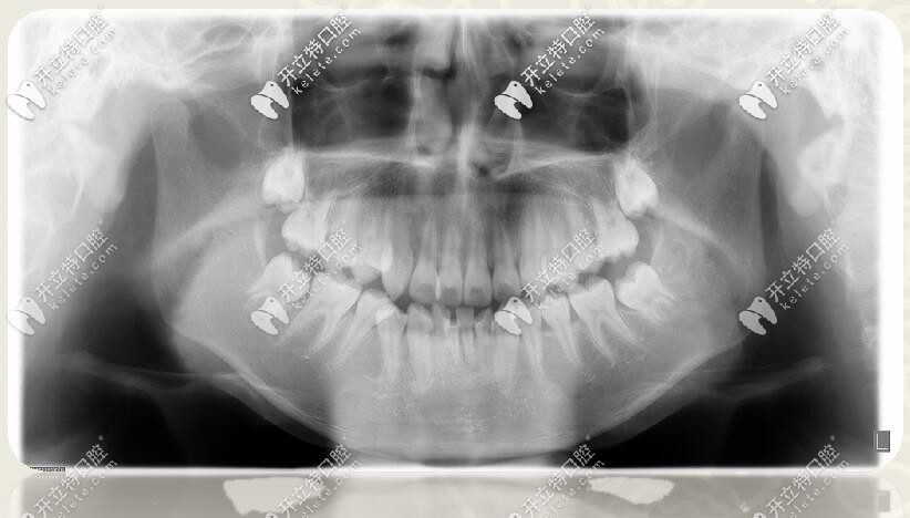 口腔全景片